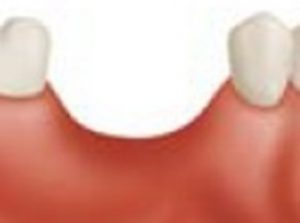 1. Bone loss after tooth loss
