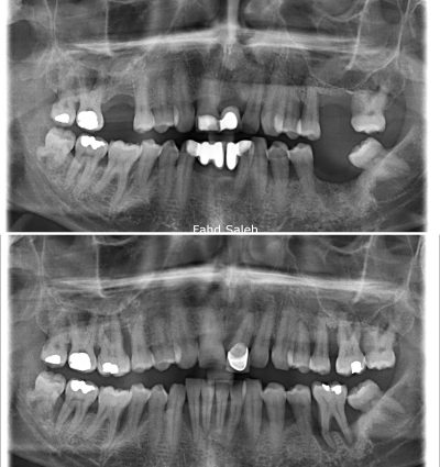 Severe bone loss due to periodontitis. Solution: Removal of hopeless teeth and non surgical debridement