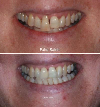 Severe Periodontitis and bone loss resulting in tooth movement. Solution: Non surgical debridement and periodontal surgery with dental reconstruction