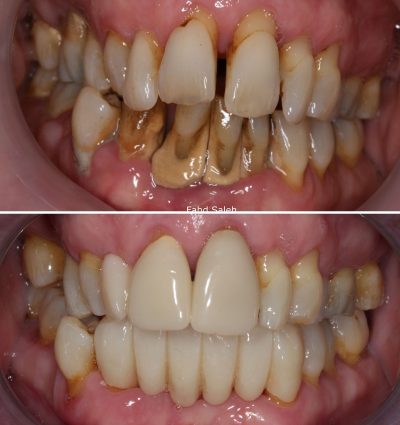 Severe Periodontitis and tooth drifting. Solution: Non surgical debridement