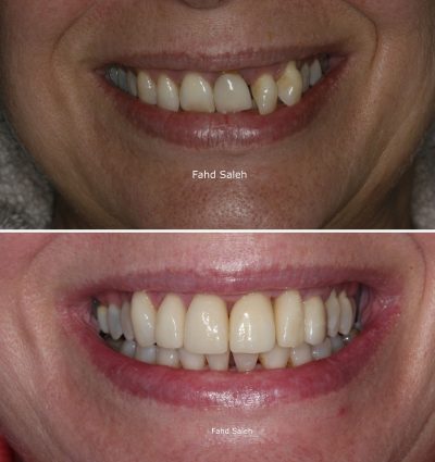 Severe Periodontitis resulting in tooth drifting. Solution: Non surgical debridement and periodontal surgery followed by bone augmentation and dental implants