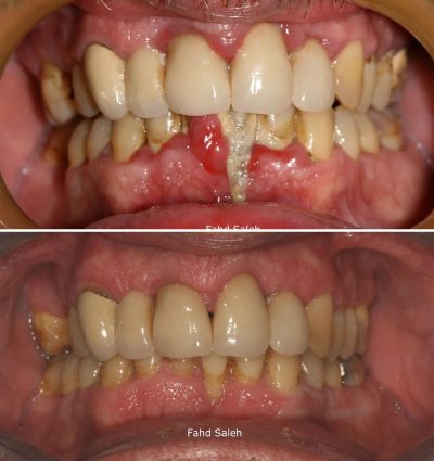 Severe Periodontitis with bleeding gum and gum swelling. Solution: Non surgical debridement