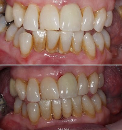 Severe Periodontitis with bleeding gums treated with resin retained bridges and non surgical debridement