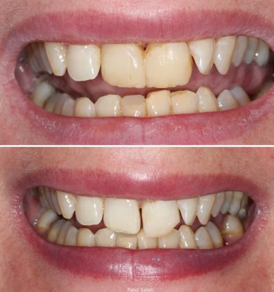 Severe periodontitis resulting in tooth drifting and looseness. Solution: Periodontal surgery and bone augmentation