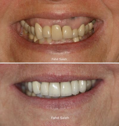 Severe gum asymmetry and failing incisor teeth. Solution: Crown lengthening surgery, dental implants and new crowns