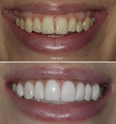 Uneven tooth shape and uneven gum development. Solution: Crown lengthening and veneers