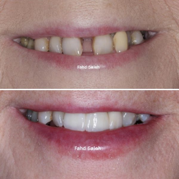Severe bone loss and drifting of teeth. Solution - Bone augmentation and bridge supported by implants