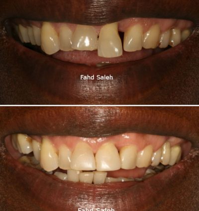 Severe periodntitis with bone loss and tooth drifting and mobility. Solution: Periodontal surgery and bone augmentation