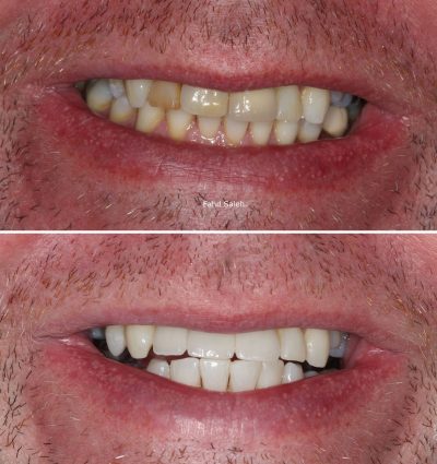 Failing upper incisors managed with partial extraction and dental implants