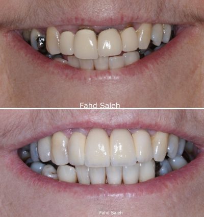 Failing upper incisors replaced with Dental implants after bone and gum augmentation
