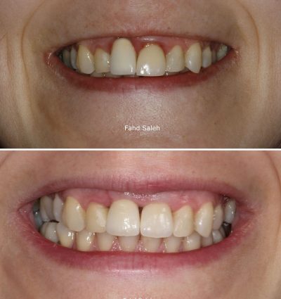 Failing upper incisors replaced with dental implants and bone augmentation