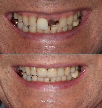 Fractured tooth and failing implant crown Managed with partial extraction, bone augmentation and dental implants
