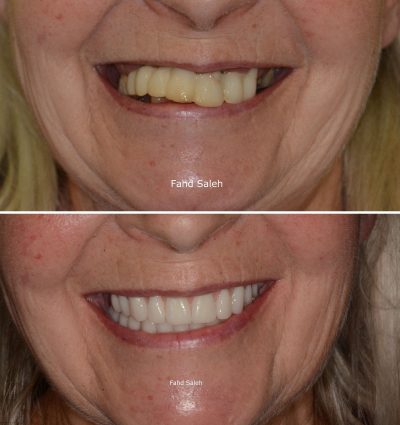 Full mouth reconstruction with Teeth in a Day protocol for the upper and lower jaw
