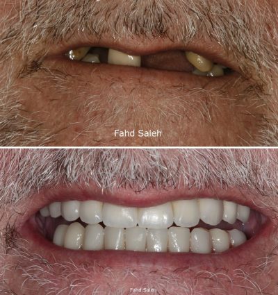 Hopeless failing teeth. Solution_ Extensive upper and lower jaw reconstruction with Teeth in a Day protocol