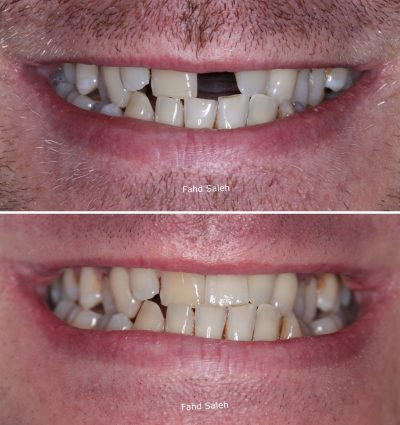 Missing tooth replaced with a dental implant after complex bone augmentation