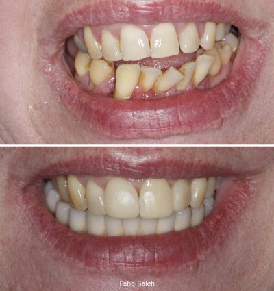 Non surgical debridement and lower jaw reconstruction with a Teeth in a Day protocol