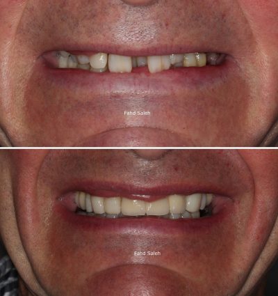 Optimisation approach with a combination of crowns and implants