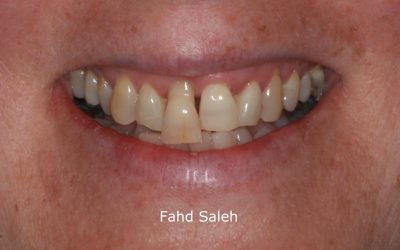 Severe Periodontitis and bone loss resulting in tooth movement.
