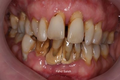Severe Periodontitis and tooth drifting.