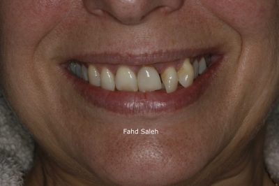 Severe Periodontitis resulting in tooth drifting.