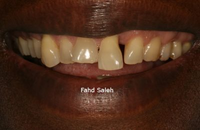 Severe periodontitis with bone loss and tooth drifting and mobility.