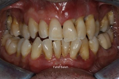 Severe periodontitis with pus discharge and bleeding gums