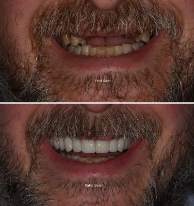 Severely failing upper teeth. Solution upper jaw reconstruction with bone augmentation and dental implants