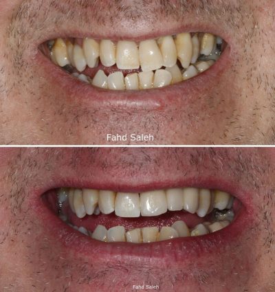 Advanced periodontitis and drifting teeth. Solution: Non surgical debridement and periodontal surgery and dental implants