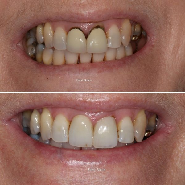 Dental decay and gum recession. Solution -mucogingival (gum graft) surgery and new crowns
